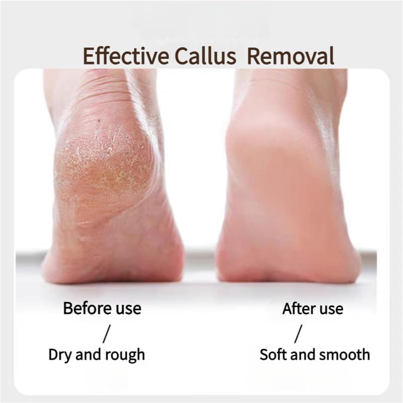 Electric Foot Callus Remover